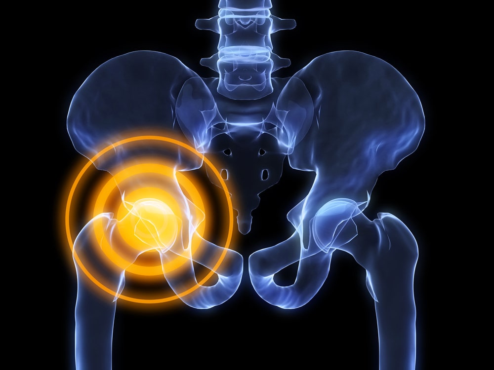El tratamiento con ejercicios adecuados puede posponer la cirugía total de cadera en pacientes con artrosis de cadera
